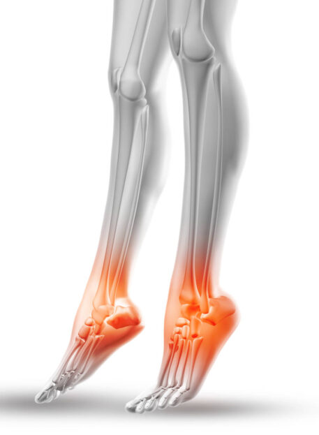 Artroza (artritis) zgornjega skočnega sklepa