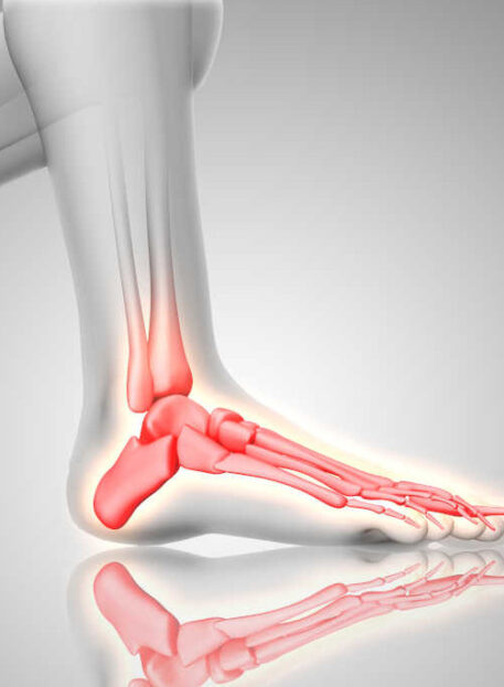 Artritis (artroza) spodnjega skočnega sklepa