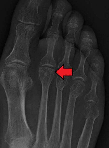 freibergova bolezen drugega prsta