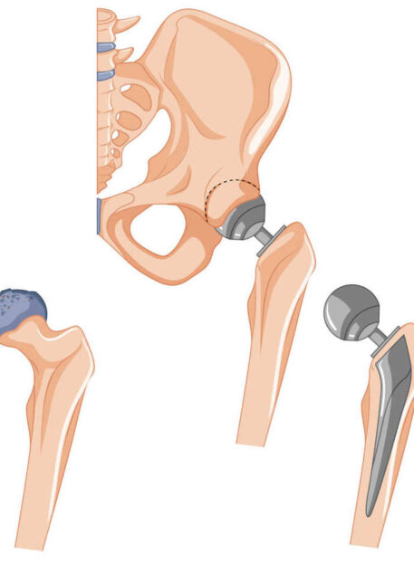 totalna endoproteza kolka