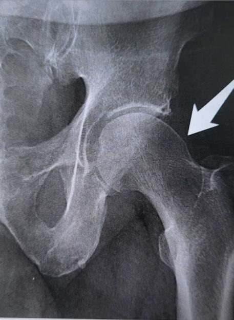 Utesnitveni sindrom kolčnega sklepa (FAI)