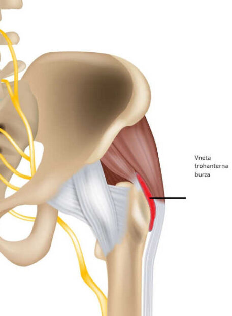 hip bursitis