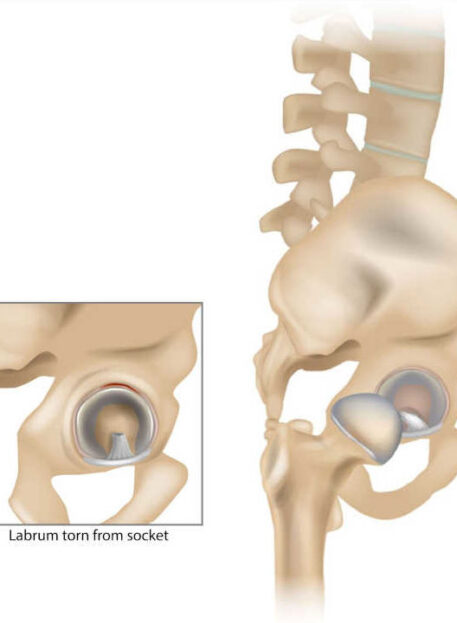 Poškodba labruma kolka