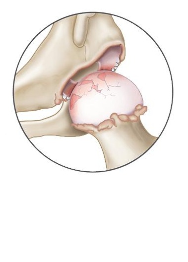 Anatomski prikaz artroze oziroma obrabe kolka