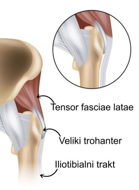sindrom pokanjva v kolcnem sklepu