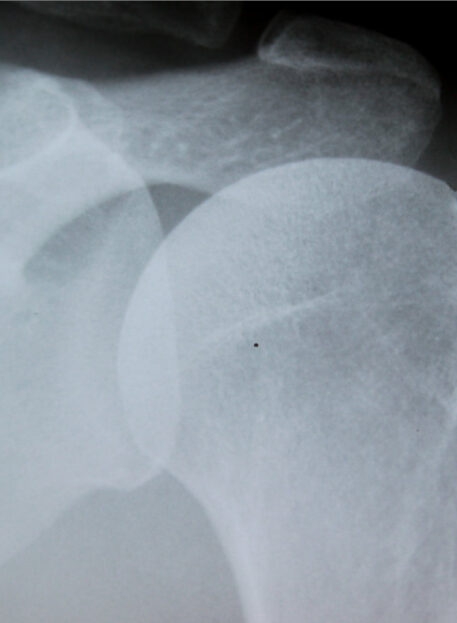 Kalcinacije rotatorne manšete