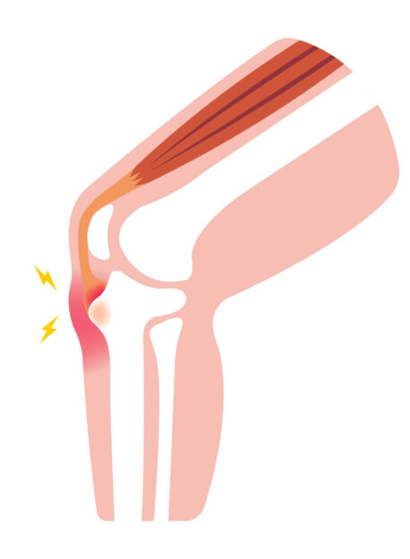 Osgood-Schlatterjev sindrom