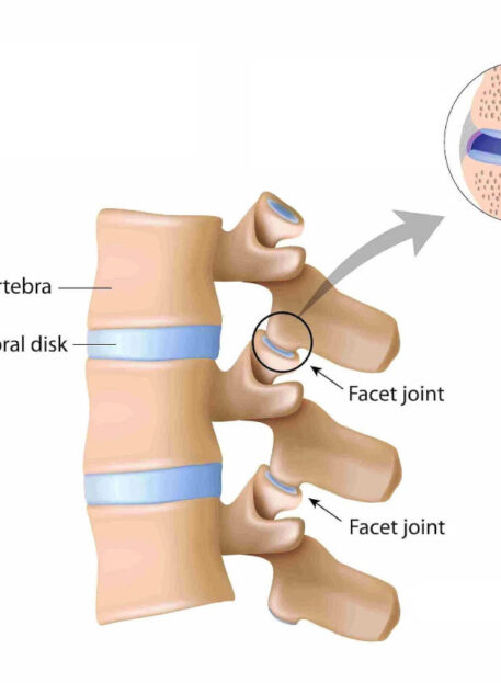 Poskodba fasetnega sklepa