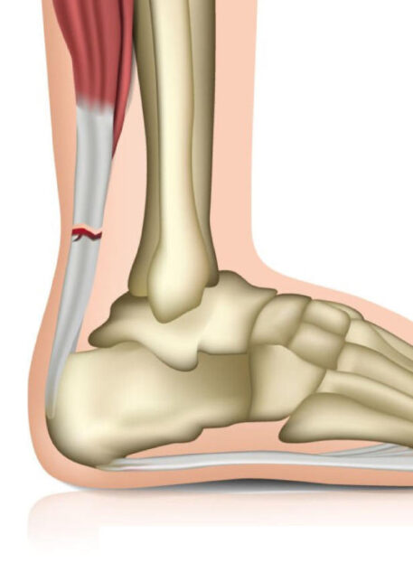 strgana mišica (ruptura mišice)
