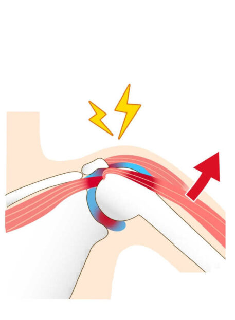 Utesnitvnei Sindrom Ramena