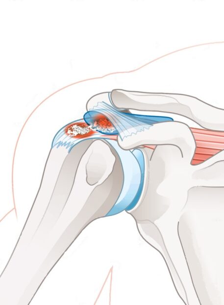 Tendinitis mišic rotatorne manšete