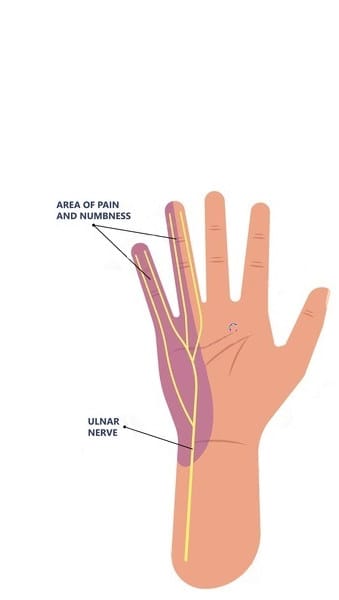 cubbital tunnel syndrom