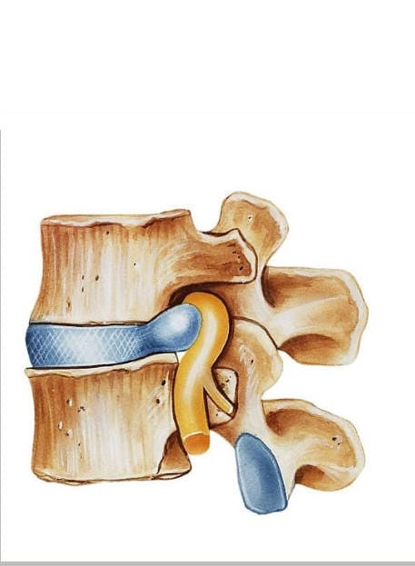 hernija ledvene hrbtenice
