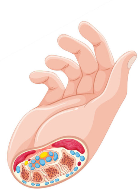 Sindrom karpalnega kanala