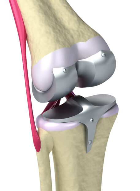 totalna endopertroza kolena