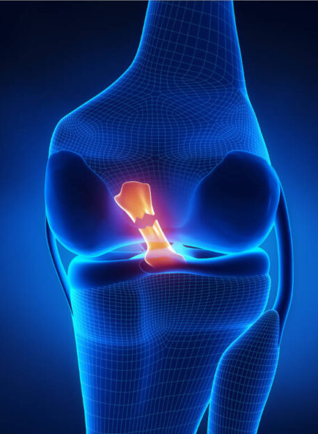 Pretrganje (ruptura) sprednje križne vezi (ACL)